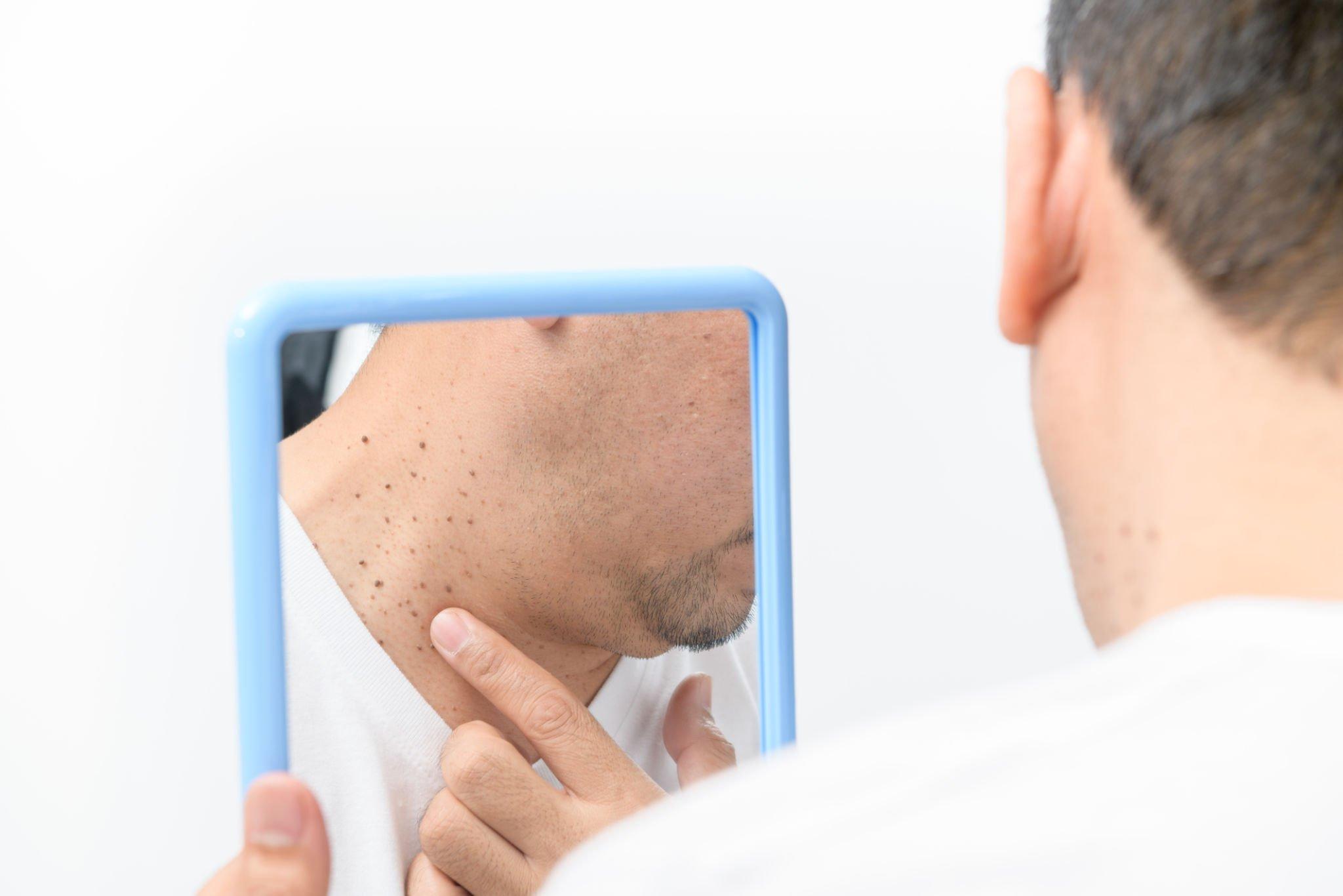 What Causes Skin Tags