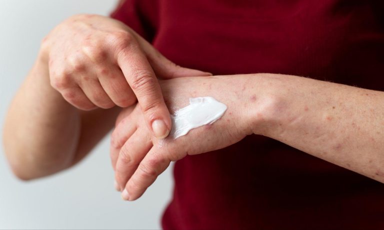 Top 4 Ingredients to Look for in an Anti-Itch Skin Cream